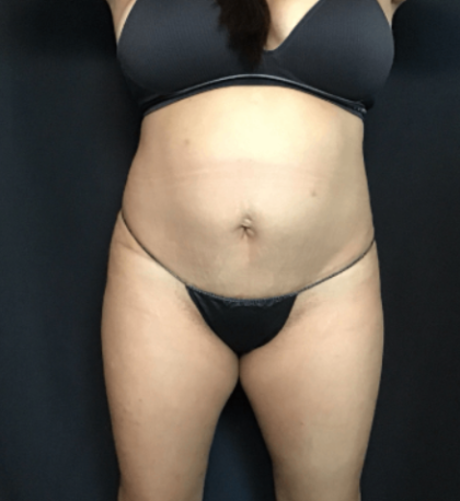Mommy Makeover Before & After Patient #1608