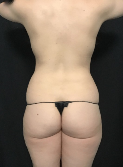 Mommy Makeover Before & After Patient #1587