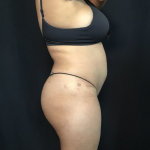 Mommy Makeover Before & After Patient #1608