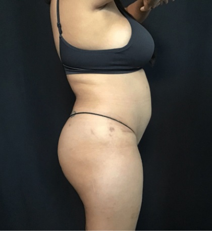 Mommy Makeover Before & After Patient #1608