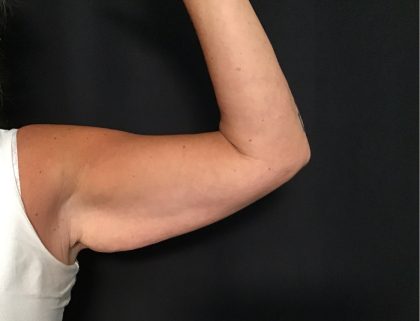 Brachioplasty Before & After Patient #1647