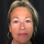 Blepharoplasty Before & After Patient #1646