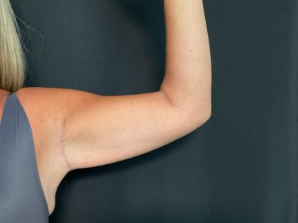 Brachioplasty Before & After Patient #1647