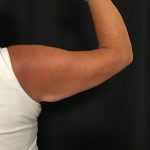 Brachioplasty Before & After Patient #1647