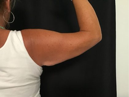 Brachioplasty Before & After Patient #1647