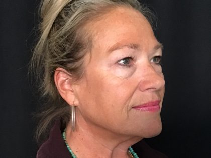 Blepharoplasty Before & After Patient #1646