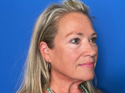 Blepharoplasty Before & After Patient #1646
