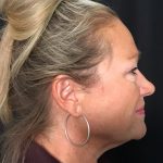 Blepharoplasty Before & After Patient #1646