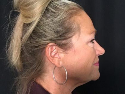 Blepharoplasty Before & After Patient #1646