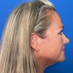 Blepharoplasty Before & After Patient #1646