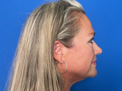 Blepharoplasty Before & After Patient #1646