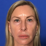 Blepharoplasty Before & After Patient #1703