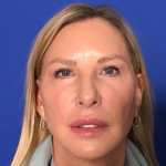 Blepharoplasty Before & After Patient #1703