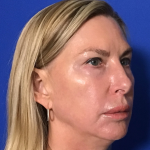 Blepharoplasty Before & After Patient #1703