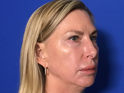 Blepharoplasty Before & After Patient #1703