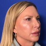 Blepharoplasty Before & After Patient #1703