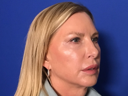 Blepharoplasty Before & After Patient #1703