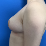Breast Reduction Before & After Patient #1702