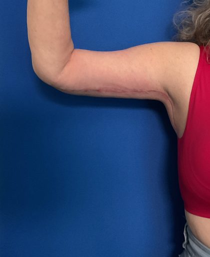Brachioplasty Before & After Patient #1741