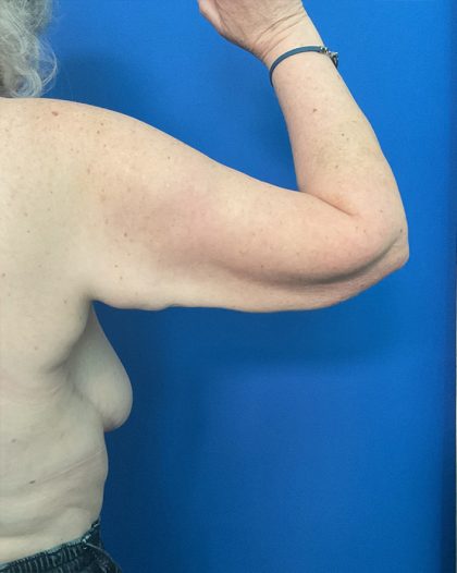 Brachioplasty Before & After Patient #1741