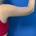 Brachioplasty Before & After Patient #1741