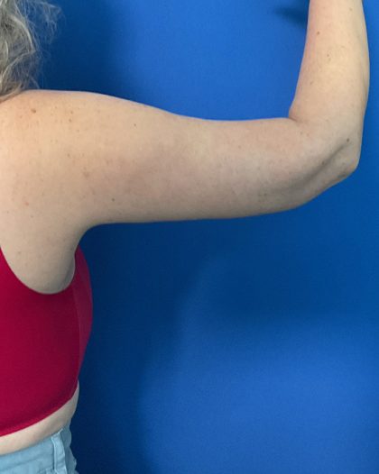 Brachioplasty Before & After Patient #1741