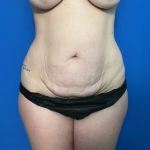 Mommy Makeover Before & After Patient #1742
