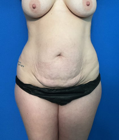 Mommy Makeover Before & After Patient #1742