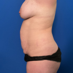 Mommy Makeover Before & After Patient #1742