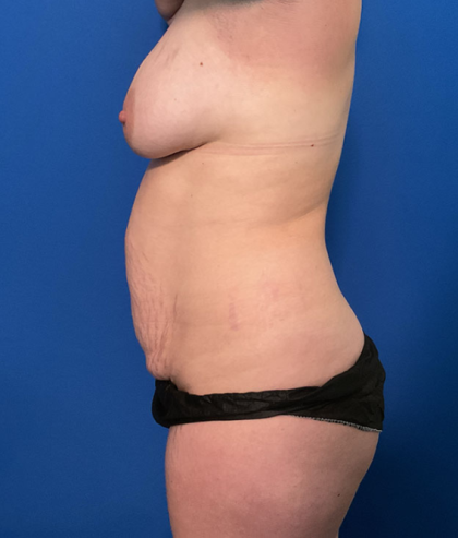 Mommy Makeover Before & After Patient #1742