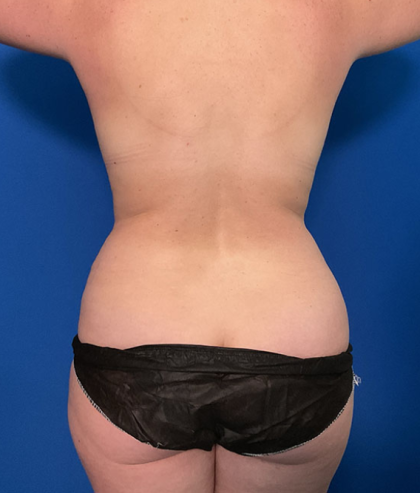 Mommy Makeover Before & After Patient #1742