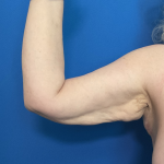 Brachioplasty Before & After Patient #1757