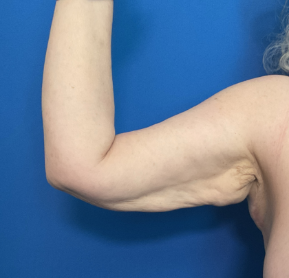 Brachioplasty Before & After Patient #1757