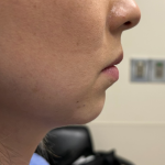 Chin Implant Before & After Patient #1758