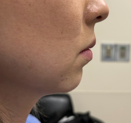 Chin Implant Before & After Patient #1758