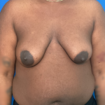 FTM Before & After Patient #1759