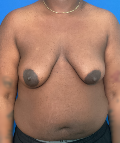 FTM Before & After Patient #1759