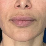 Lip Lift Before & After Patient #1761