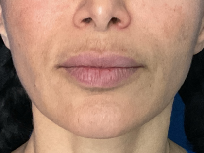 Lip Lift Before & After Patient #1761