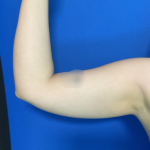 Liposuction Arms Before & After Patient #1762