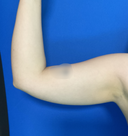 Liposuction Arms Before & After Patient #1762