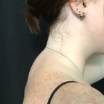 Liposuction of the Back of the Neck Before & After Patient #1763