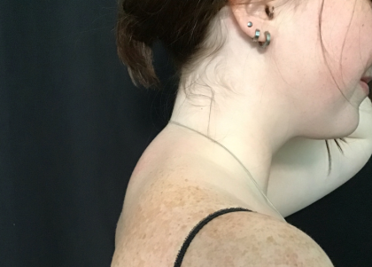 Liposuction of the Back of the Neck Before & After Patient #1763