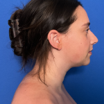 Neck Liposuction Before & After Patient #1764