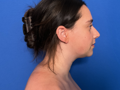 Neck Liposuction Before & After Patient #1764
