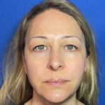 Blepharoplasty Before & After Patient #1765
