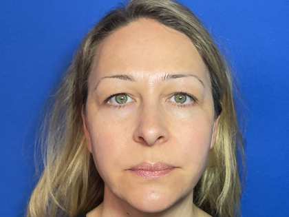 Blepharoplasty Before & After Patient #1765