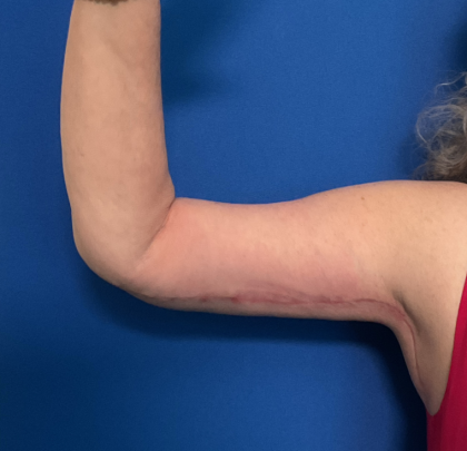 Brachioplasty Before & After Patient #1757
