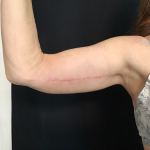 Brachioplasty Before & After Patient #1756