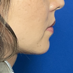 Chin Implant Before & After Patient #1758